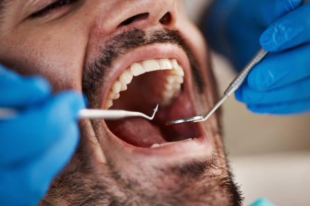Best Knocked-Out Tooth Emergency  in Northdale, FL